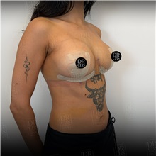 Breast Lift After Photo by Cem Berkay SINACI, MD; Istanbul, M - Case 51386