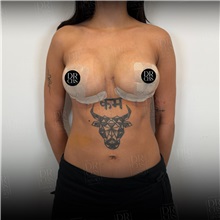 Breast Lift After Photo by Cem Berkay SINACI, MD; Istanbul, M - Case 51386