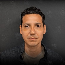 Rhinoplasty After Photo by Cem Berkay SINACI, MD; Istanbul, M - Case 51389