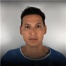 Rhinoplasty Before Photo by Cem Berkay SINACI, MD; Istanbul, M - Case 51389
