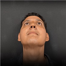 Rhinoplasty After Photo by Cem Berkay SINACI, MD; Istanbul, M - Case 51389