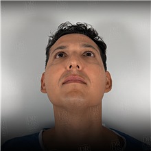Rhinoplasty Before Photo by Cem Berkay SINACI, MD; Istanbul, M - Case 51389