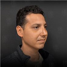Rhinoplasty After Photo by Cem Berkay SINACI, MD; Istanbul, M - Case 51389