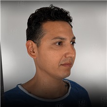 Rhinoplasty Before Photo by Cem Berkay SINACI, MD; Istanbul, M - Case 51389