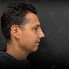Rhinoplasty After Photo by Cem Berkay SINACI, MD; Istanbul, M - Case 51389