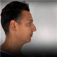 Rhinoplasty Before Photo by Cem Berkay SINACI, MD; Istanbul, M - Case 51389