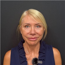 Facelift After Photo by Cem Berkay SINACI, MD; Istanbul, M - Case 51449