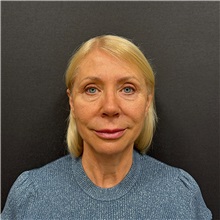 Facelift Before Photo by Cem Berkay SINACI, MD; Istanbul, M - Case 51449
