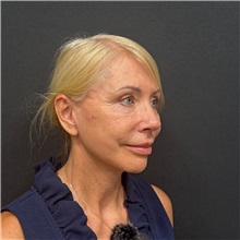 Facelift After Photo by Cem Berkay SINACI, MD; Istanbul, M - Case 51449