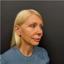 Facelift Before Photo by Cem Berkay SINACI, MD; Istanbul, M - Case 51449