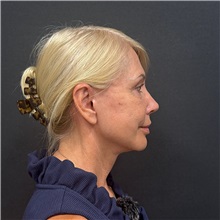Facelift After Photo by Cem Berkay SINACI, MD; Istanbul, M - Case 51449