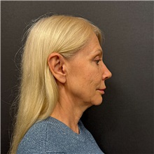 Facelift Before Photo by Cem Berkay SINACI, MD; Istanbul, M - Case 51449
