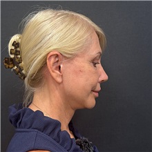 Facelift After Photo by Cem Berkay SINACI, MD; Istanbul, M - Case 51449
