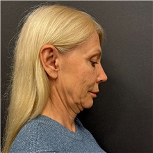 Facelift Before Photo by Cem Berkay SINACI, MD; Istanbul, M - Case 51449