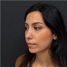Rhinoplasty After Photo by Cem Berkay SINACI, MD; Istanbul, M - Case 51457