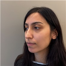 Rhinoplasty Before Photo by Cem Berkay SINACI, MD; Istanbul, M - Case 51457