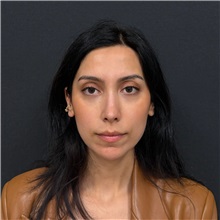 Rhinoplasty After Photo by Cem Berkay SINACI, MD; Istanbul, M - Case 51457