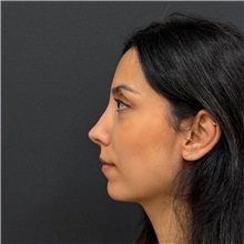 Rhinoplasty After Photo by Cem Berkay SINACI, MD; Istanbul, M - Case 51457