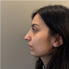 Rhinoplasty Before Photo by Cem Berkay SINACI, MD; Istanbul, M - Case 51457