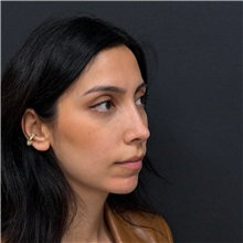 Rhinoplasty After Photo by Cem Berkay SINACI, MD; Istanbul, M - Case 51457