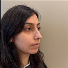 Rhinoplasty Before Photo by Cem Berkay SINACI, MD; Istanbul, M - Case 51457
