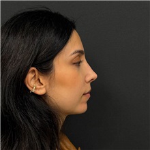Rhinoplasty After Photo by Cem Berkay SINACI, MD; Istanbul, M - Case 51457