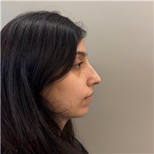 Rhinoplasty Before Photo by Cem Berkay SINACI, MD; Istanbul, M - Case 51457