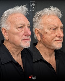 Facelift After Photo by Cem Berkay SINACI, MD; Istanbul, M - Case 51498