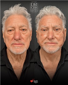 Facelift Before Photo by Cem Berkay SINACI, MD; Istanbul, M - Case 51498