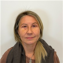 Eyelid Surgery After Photo by Cem Berkay SINACI, MD; Istanbul, M - Case 51543