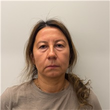 Eyelid Surgery Before Photo by Cem Berkay SINACI, MD; Istanbul, M - Case 51543