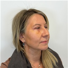 Eyelid Surgery After Photo by Cem Berkay SINACI, MD; Istanbul, M - Case 51543