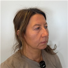 Eyelid Surgery Before Photo by Cem Berkay SINACI, MD; Istanbul, M - Case 51543