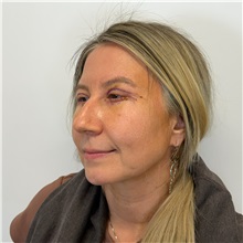 Eyelid Surgery After Photo by Cem Berkay SINACI, MD; Istanbul, M - Case 51543