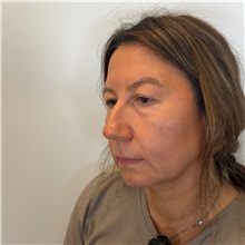 Eyelid Surgery Before Photo by Cem Berkay SINACI, MD; Istanbul, M - Case 51543