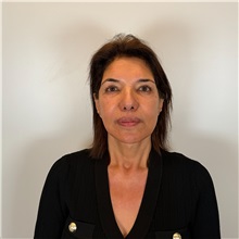 Facelift After Photo by Cem Berkay SINACI, MD; Istanbul, M - Case 51544