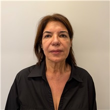 Facelift Before Photo by Cem Berkay SINACI, MD; Istanbul, M - Case 51544