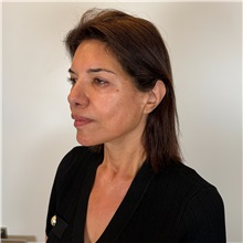 Facelift After Photo by Cem Berkay SINACI, MD; Istanbul, M - Case 51544