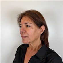 Facelift Before Photo by Cem Berkay SINACI, MD; Istanbul, M - Case 51544