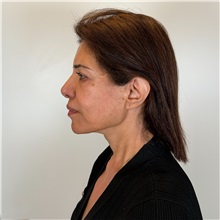 Facelift After Photo by Cem Berkay SINACI, MD; Istanbul, M - Case 51544