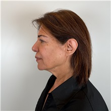 Facelift Before Photo by Cem Berkay SINACI, MD; Istanbul, M - Case 51544
