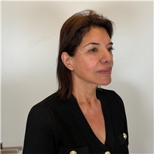 Facelift After Photo by Cem Berkay SINACI, MD; Istanbul, M - Case 51544