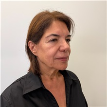 Facelift Before Photo by Cem Berkay SINACI, MD; Istanbul, M - Case 51544