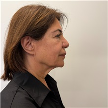 Facelift Before Photo by Cem Berkay SINACI, MD; Istanbul, M - Case 51544