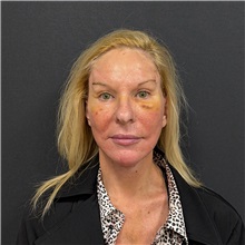 Facelift After Photo by Cem Berkay SINACI, MD; Istanbul, M - Case 51597
