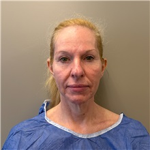 Facelift Before Photo by Cem Berkay SINACI, MD; Istanbul, M - Case 51597