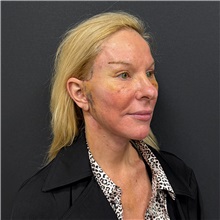 Facelift After Photo by Cem Berkay SINACI, MD; Istanbul, M - Case 51597