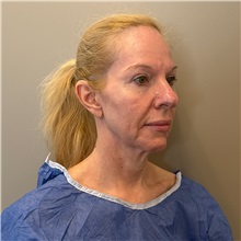 Facelift Before Photo by Cem Berkay SINACI, MD; Istanbul, M - Case 51597