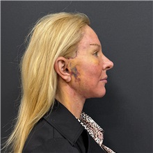 Facelift After Photo by Cem Berkay SINACI, MD; Istanbul, M - Case 51597