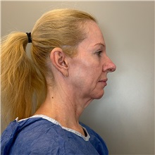 Facelift Before Photo by Cem Berkay SINACI, MD; Istanbul, M - Case 51597